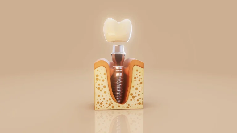 Implantes Straumann en Clínica Dental Barros qué son y qué aportan a tu tratamiento de implantes en baiona barros